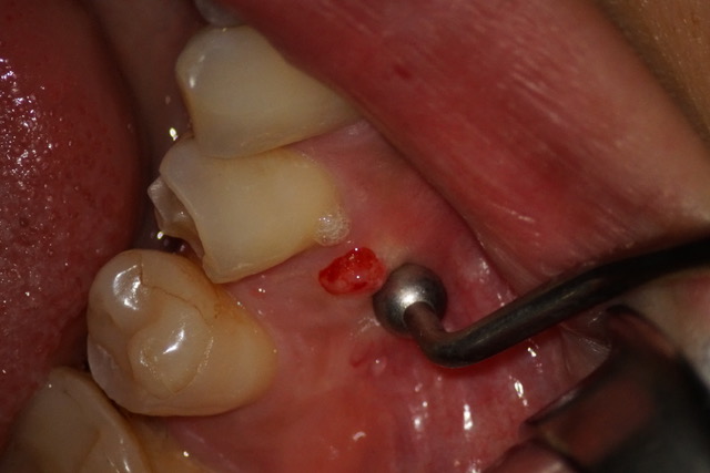 歯茎に膿が溜まる写真