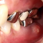 根管治療の失敗？虫歯の再発や、再治療を受ける際の注意点について