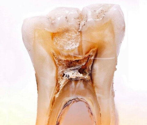 虫歯の神経