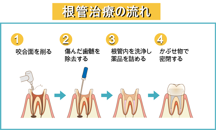 根管治療の図解