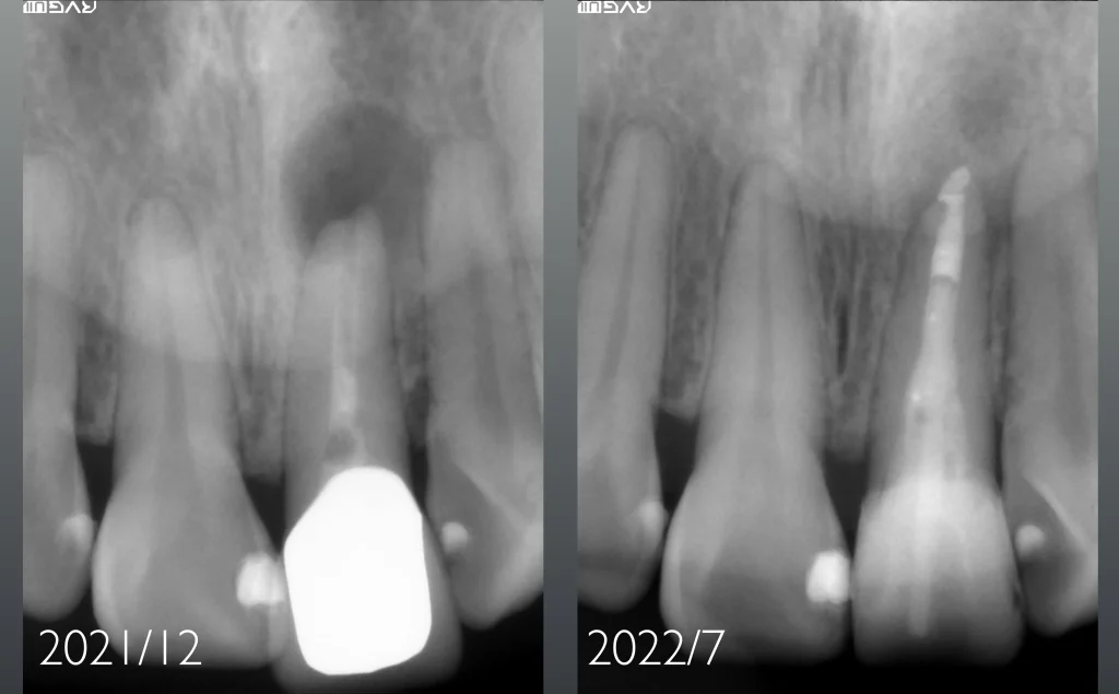 きちんとした根管治療を行えば、大きな骨欠損があっても生体、骨は再生されます。ここのケースは１回目のアポイント時に、根管内を清潔に可能な限り無菌化をしてMTA(バイオセラミック）材料を根管充填をして２回目のアポイント時にファイバーコアを築造したケースです。通常大きな骨欠損があっても根管充填後、約2月程度でレントゲン上で反応があることが多くあります。