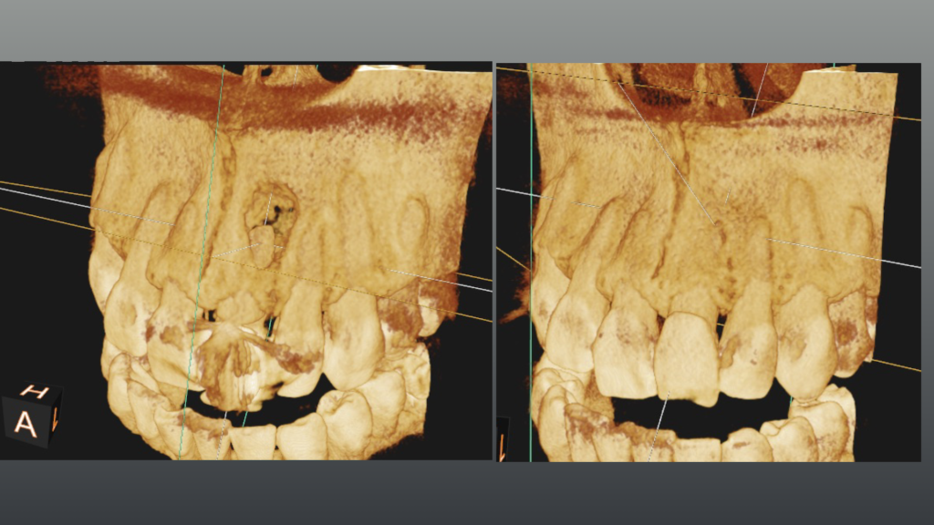 根管治療で抜歯してインプラント治療にならずに自分の歯を保存、根尖部に骨の再生が認める