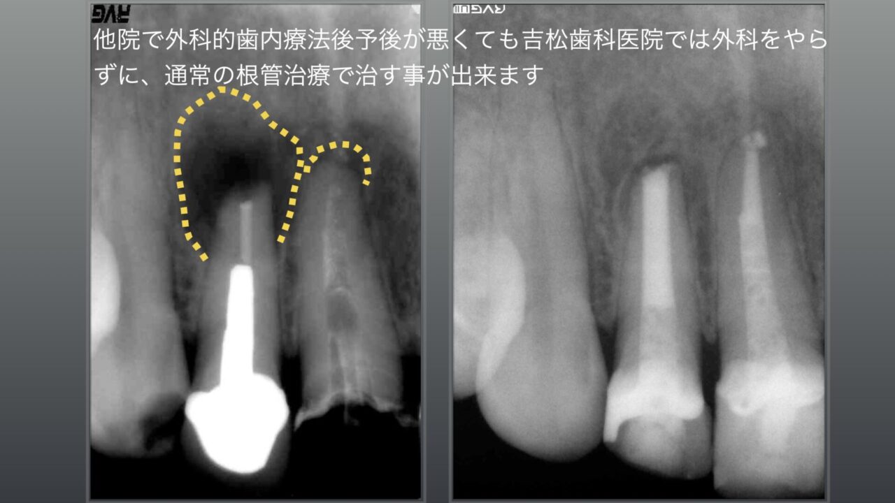 他院で出来なくても吉松歯科医院では出来る、治せる非外科的根管治療、術前黄色の点線部の骨が無くなっていますが、治療後は骨が再生されてます