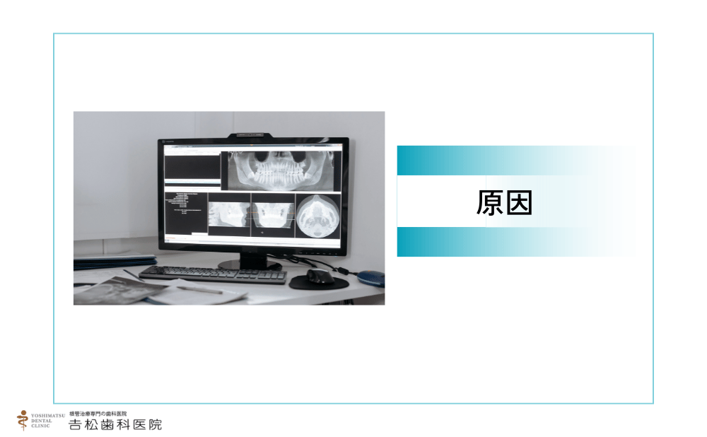 感染根管処置が起こる原因
