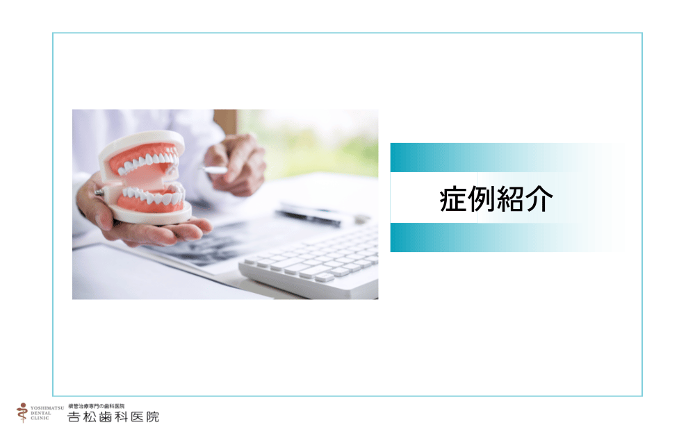 感染根管処置治療の症例紹介