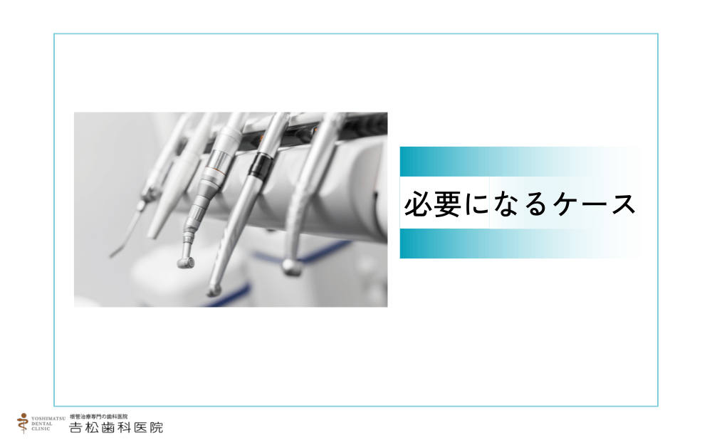 抜髄が必要になるケース