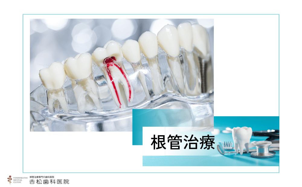 根管治療後の違和感が続くときに知っておきたい原因と受診のサインをご紹介