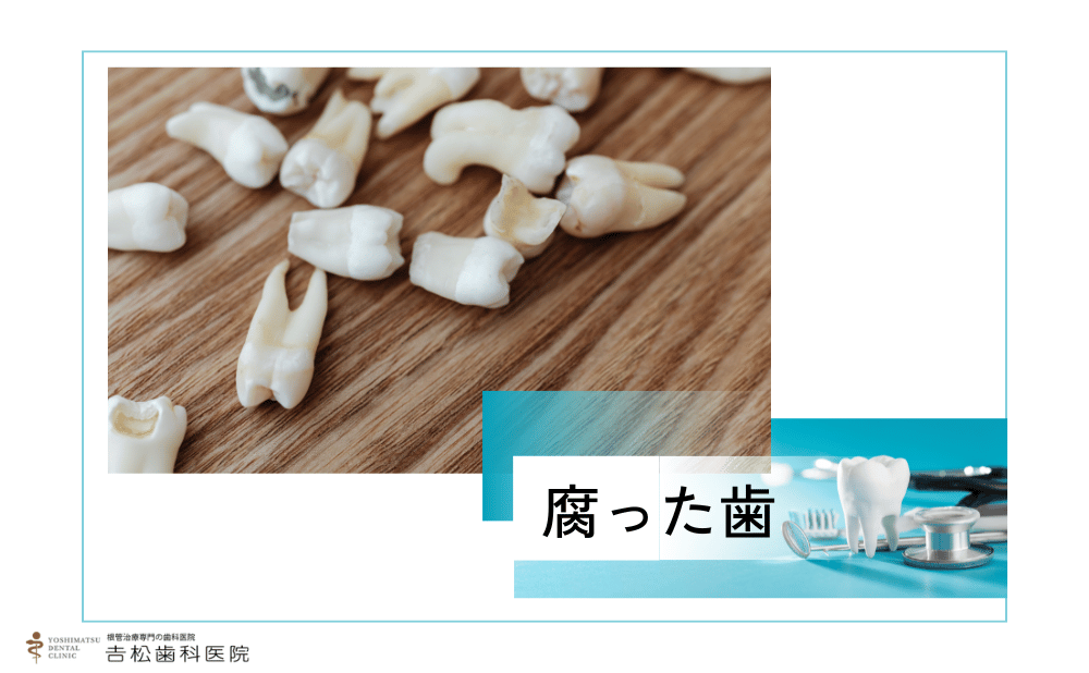 腐った歯は抜くしかない？放置リスクと治療方法をご紹介