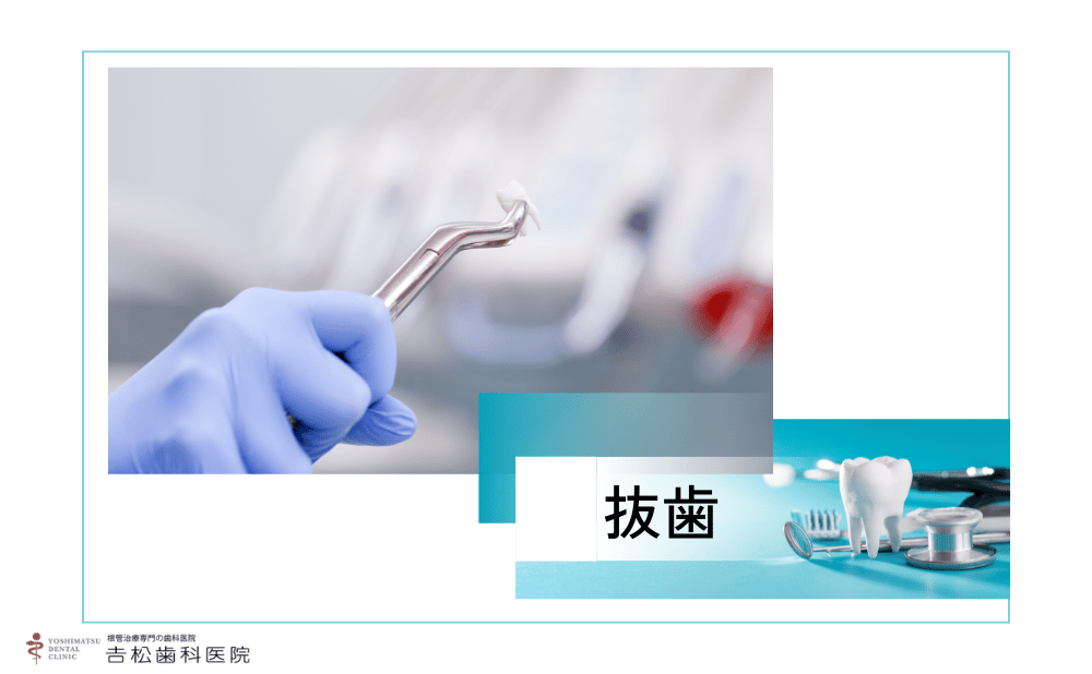 抜歯と言われたけど諦めない！根管治療で歯を残すために知っておきたいこと