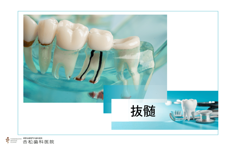 歯の神経を抜く前に知っておきたい放置リスクと症例をご紹介