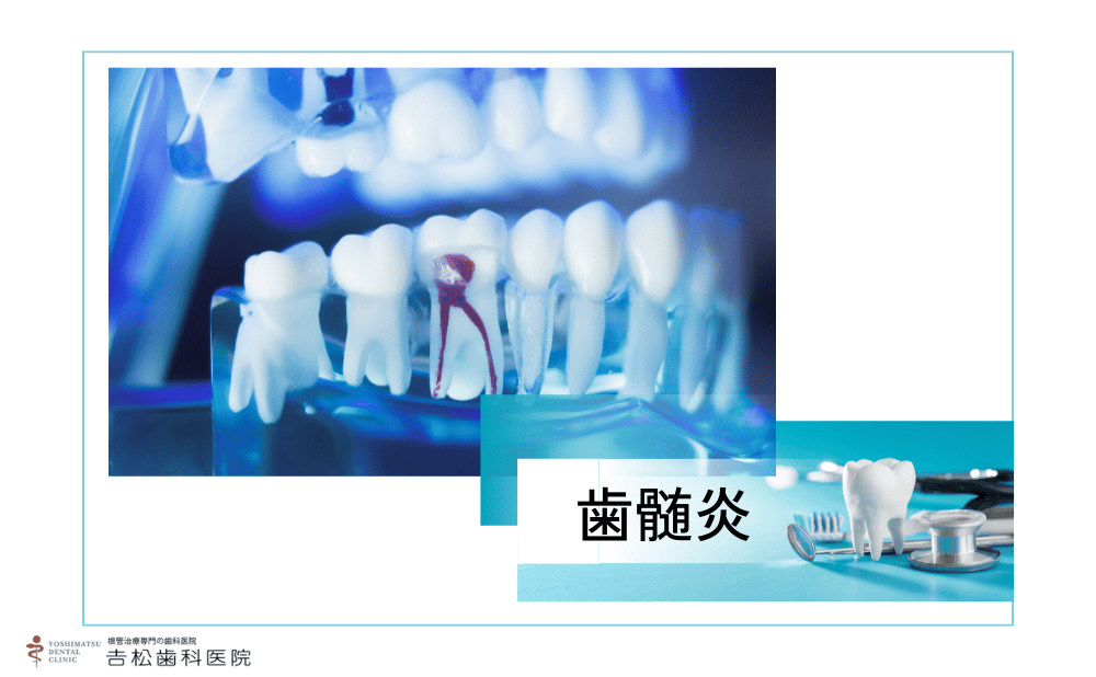 歯髄炎の激痛はいつまで続く？痛みの期間と治療法、実際の症例を解説