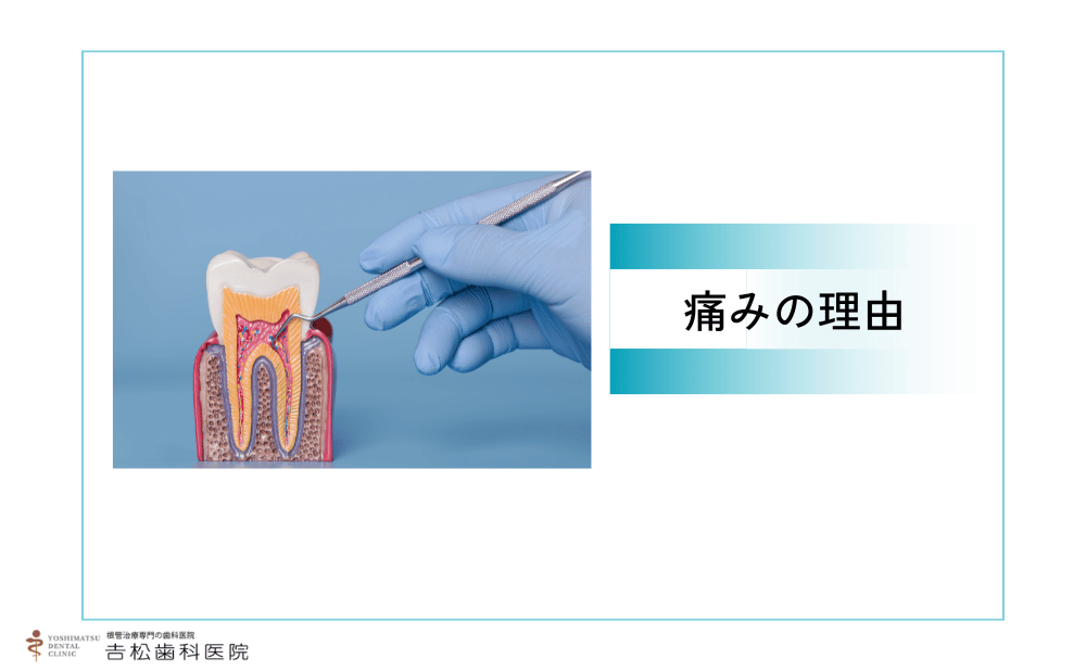 再根管治療の基本と痛みが出やすい理由