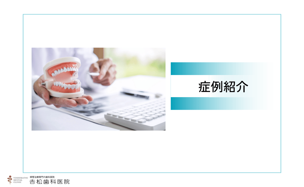 再根管治療の症例紹介