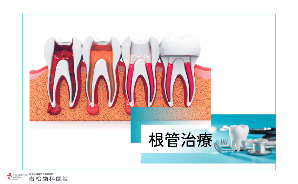 感染根管治療の流れを徹底解説！治療手順や期間をわかりやすくご紹介