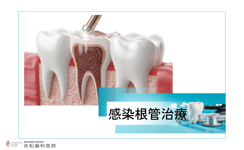 感染根管治療の費用相場は？保険・自費どっちが良いか成功率まで徹底解説