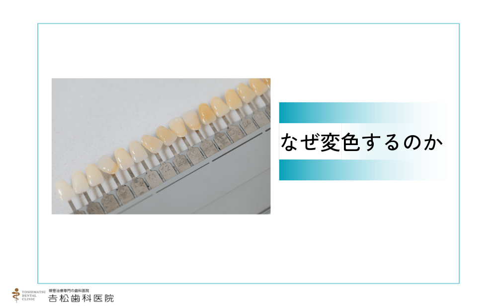 神経を抜いた前歯はなぜ変色する？